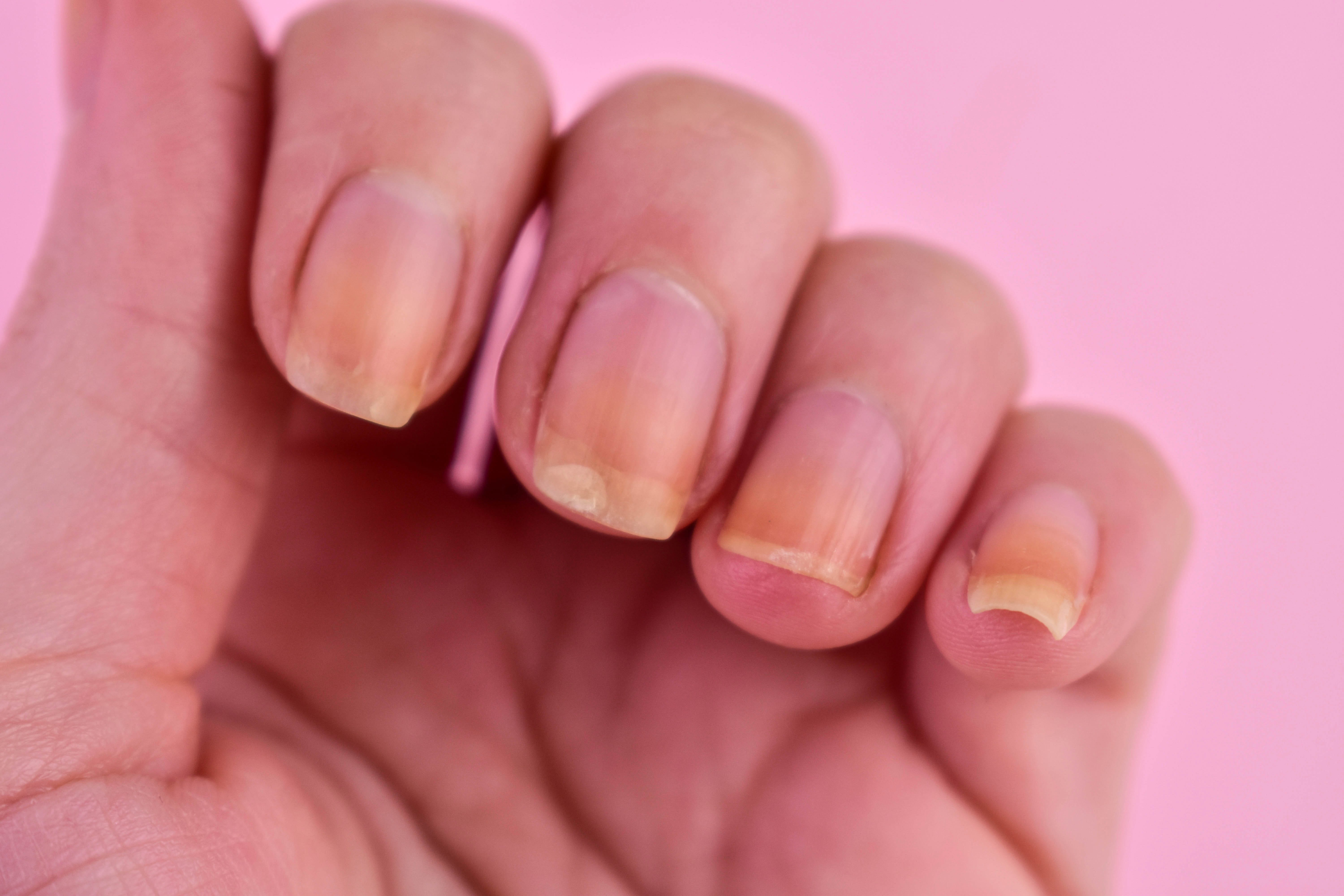 5 Causes of Yellow Nails (and How to Get Rid of Them), According to Experts